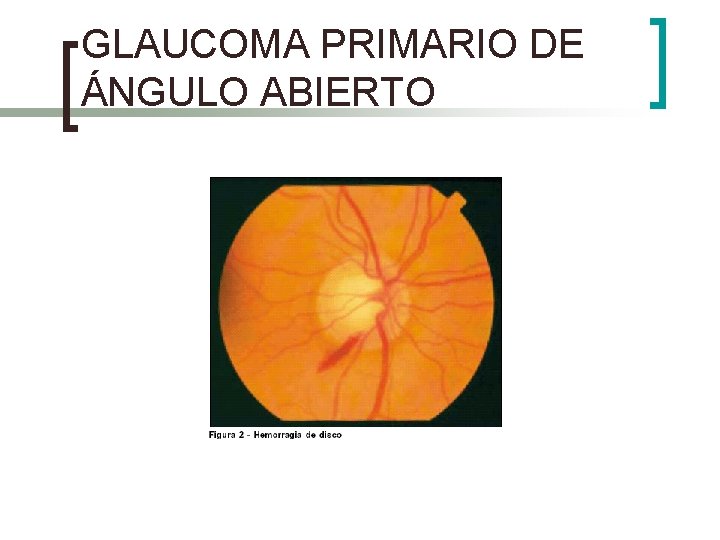 GLAUCOMA PRIMARIO DE ÁNGULO ABIERTO 