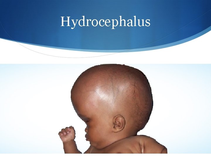 Hydrocephalus 