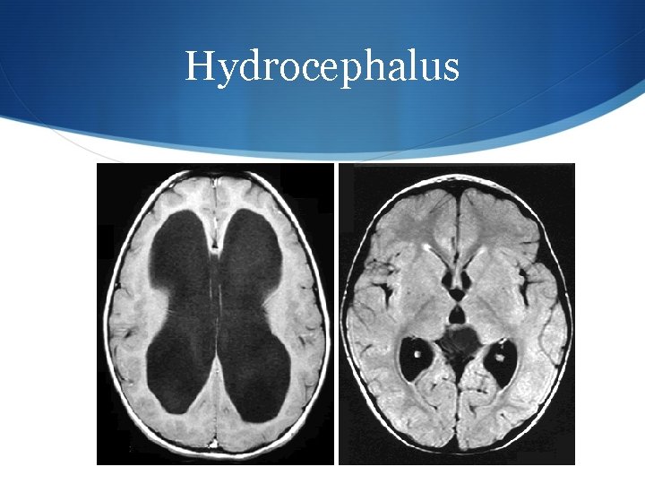 Hydrocephalus 