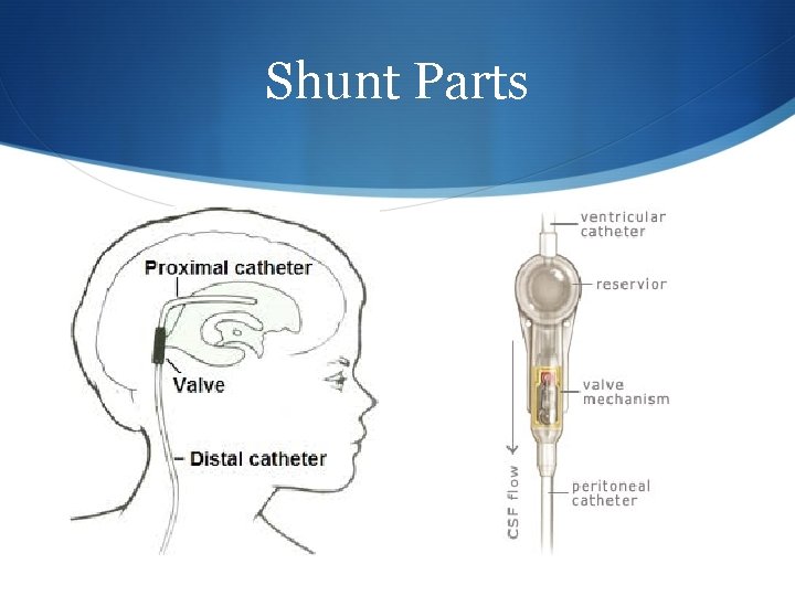 Shunt Parts 
