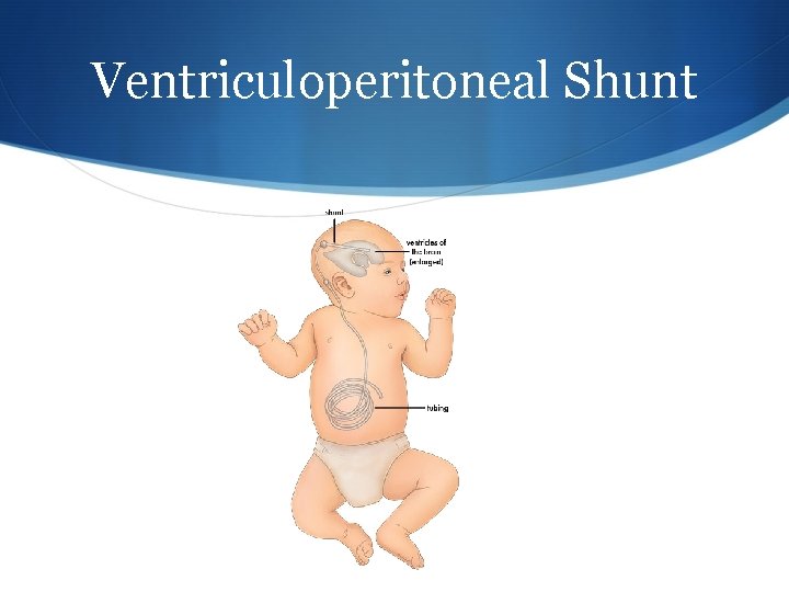 Ventriculoperitoneal Shunt 