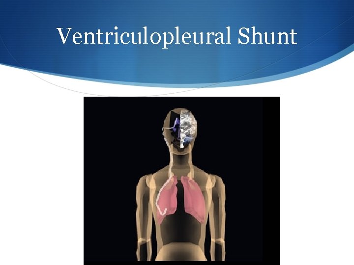 Ventriculopleural Shunt 