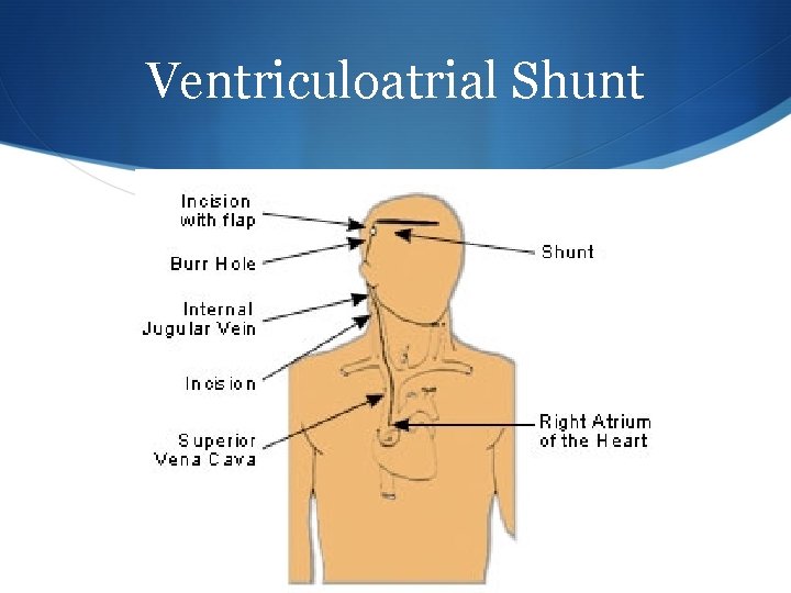 Ventriculoatrial Shunt 