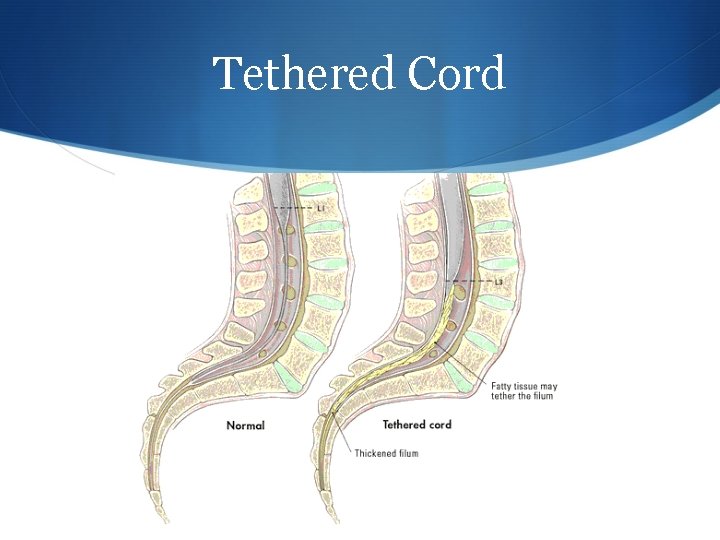 Tethered Cord 
