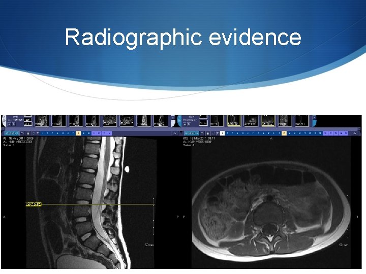 Radiographic evidence 