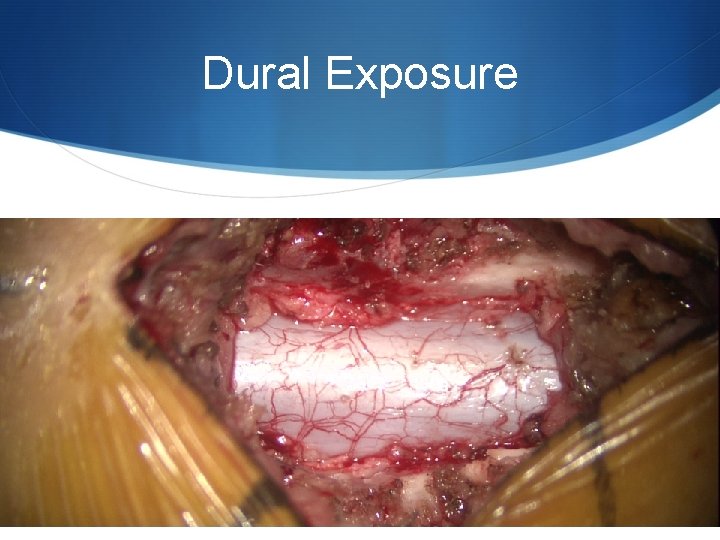 Dural Exposure 