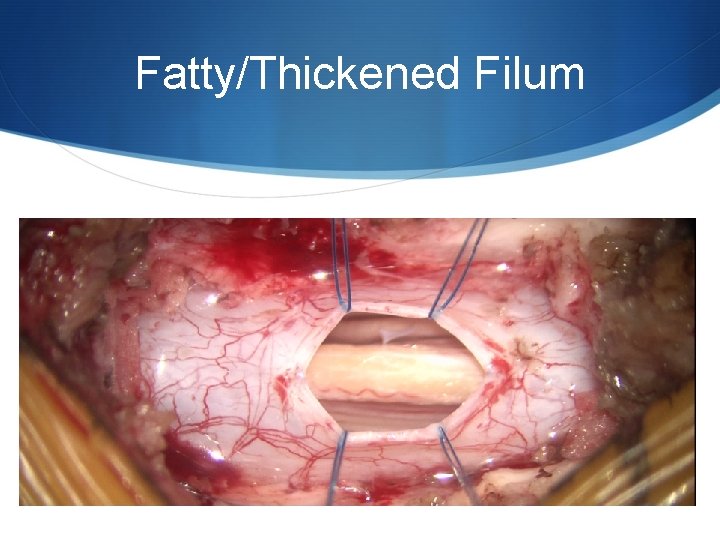Fatty/Thickened Filum 