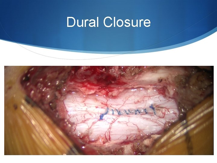 Dural Closure 