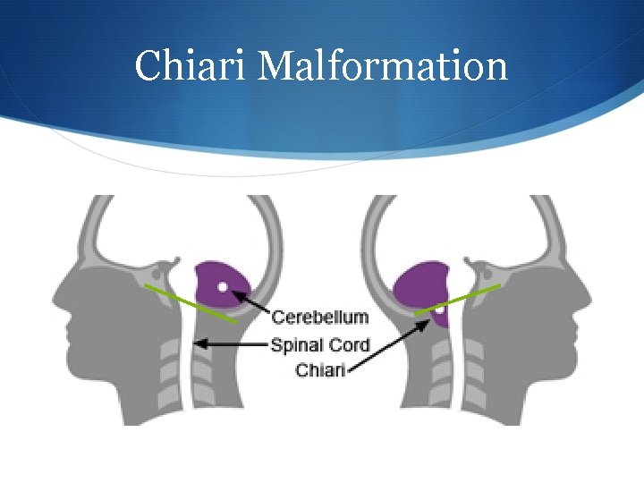 Chiari Malformation 