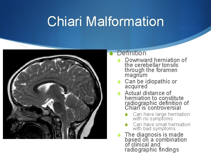 Chiari Malformation S Definition S Downward herniation of the cerebellar tonsils through the foramen