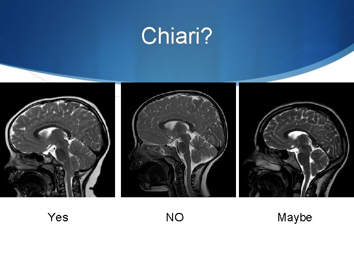 Chiari? Yes NO Maybe 