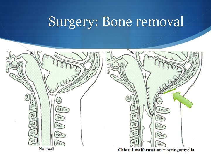 Surgery: Bone removal 