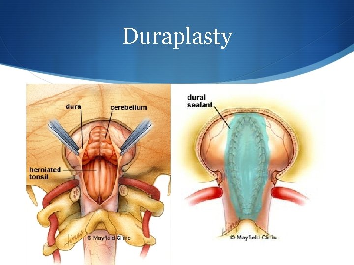 Duraplasty 