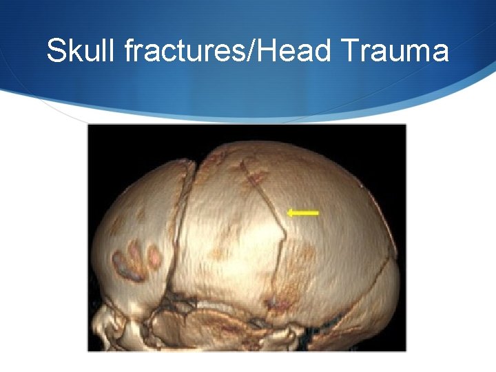 Skull fractures/Head Trauma 