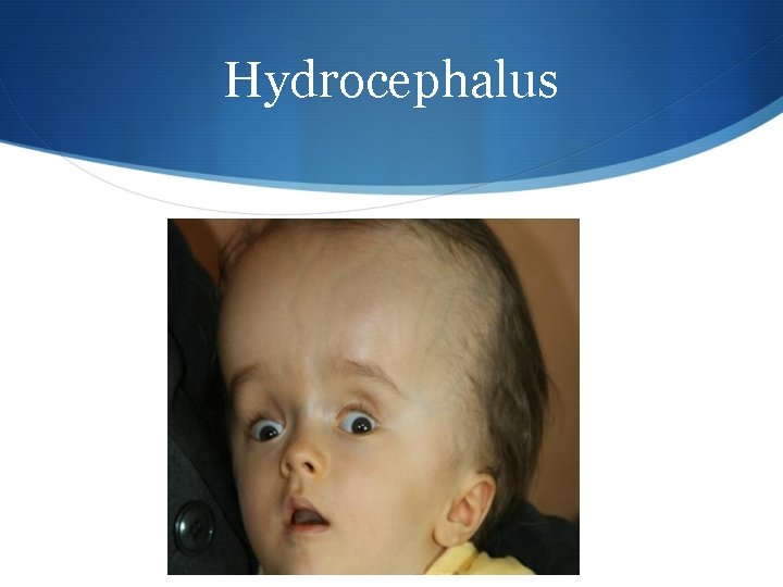 Hydrocephalus 