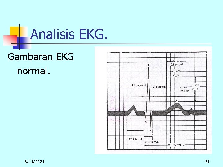 Analisis EKG. Gambaran EKG normal. 3/11/2021 31 