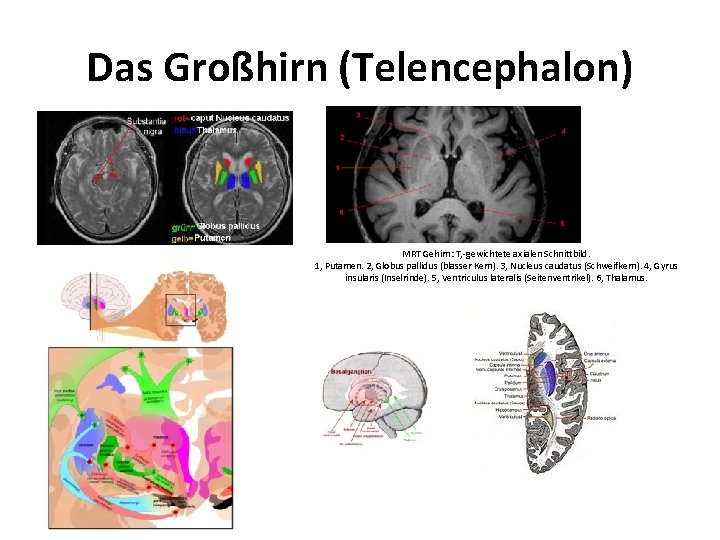Das Großhirn (Telencephalon) MRT Gehirn: T, -gewichtete axialen Schnittbild. 1, Putamen. 2, Globus pallidus