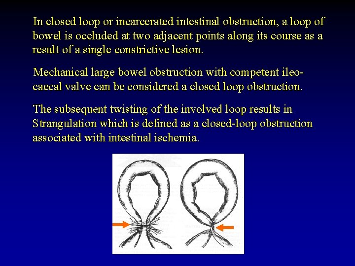 In closed loop or incarcerated intestinal obstruction, a loop of bowel is occluded at