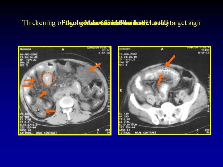 Thickening of. Pneumatosis Engorgement the bowel Mesenteric Associated wall (Air of with Mesenteric in.