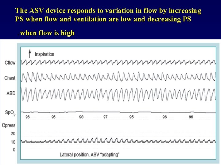 The ASV device responds to variation in flow by increasing PS when flow and