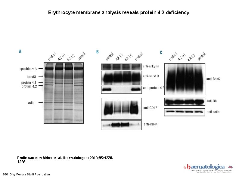 Erythrocyte membrane analysis reveals protein 4. 2 deficiency. Emile van den Akker et al.