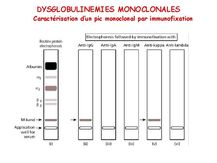 DYSGLOBULINEMIES MONOCLONALES Caractérisation d’un pic monoclonal par immunofixation 