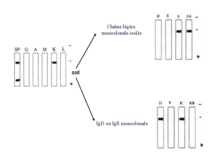 Chaîne légère monoclonale isolée soit Ig. D ou Ig. E monoclonale 