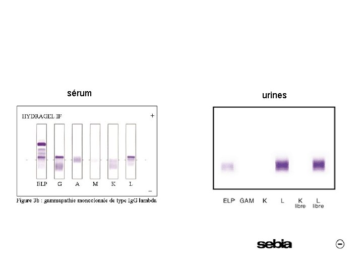 sérum urines 