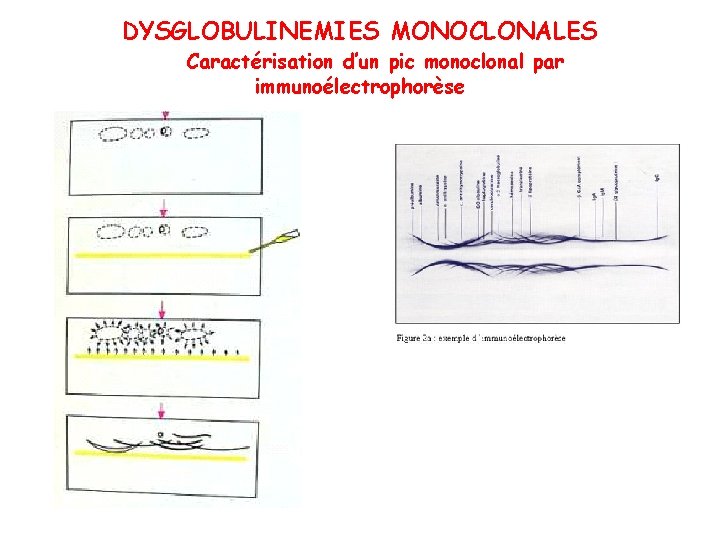 DYSGLOBULINEMIES MONOCLONALES Caractérisation d’un pic monoclonal par immunoélectrophorèse 