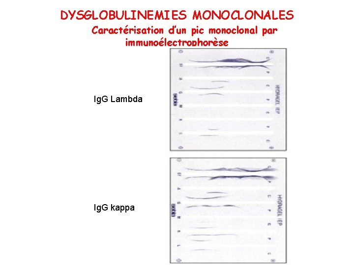 DYSGLOBULINEMIES MONOCLONALES Caractérisation d’un pic monoclonal par immunoélectrophorèse Ig. G Lambda Ig. G kappa