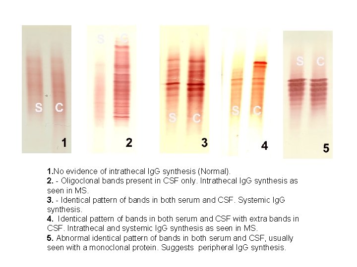 1. No evidence of intrathecal Ig. G synthesis (Normal). 2. - Oligoclonal bands present