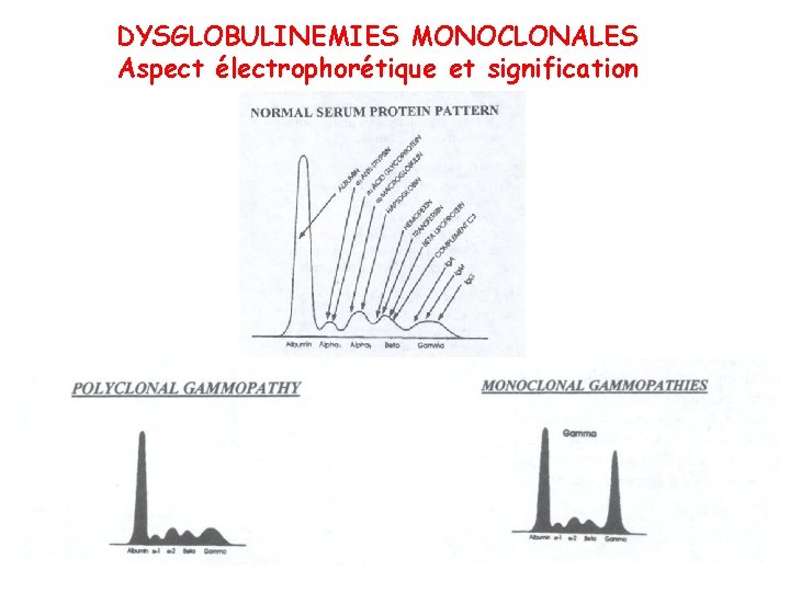 DYSGLOBULINEMIES MONOCLONALES Aspect électrophorétique et signification 