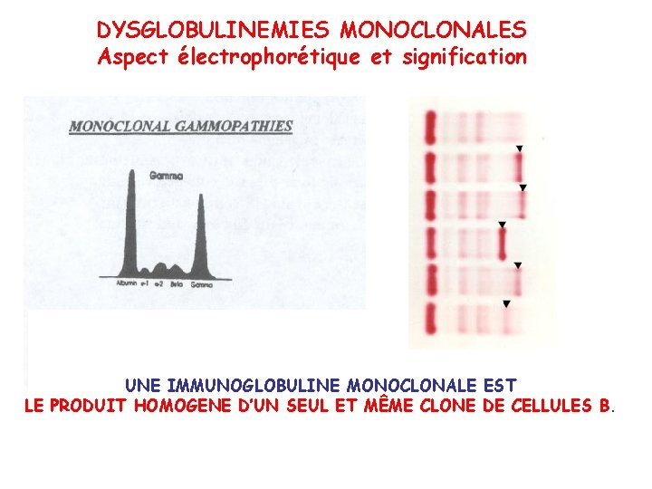 DYSGLOBULINEMIES MONOCLONALES Aspect électrophorétique et signification UNE IMMUNOGLOBULINE MONOCLONALE EST LE PRODUIT HOMOGENE D’UN