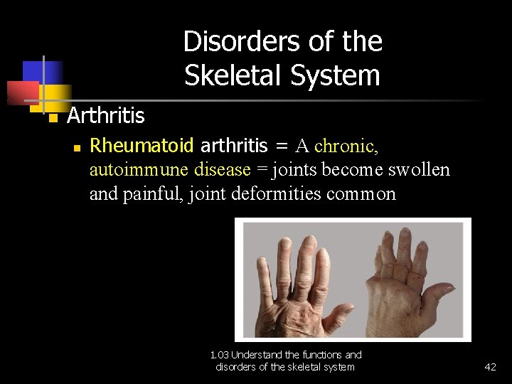 Disorders of the Skeletal System n Arthritis n Rheumatoid arthritis = A chronic, autoimmune