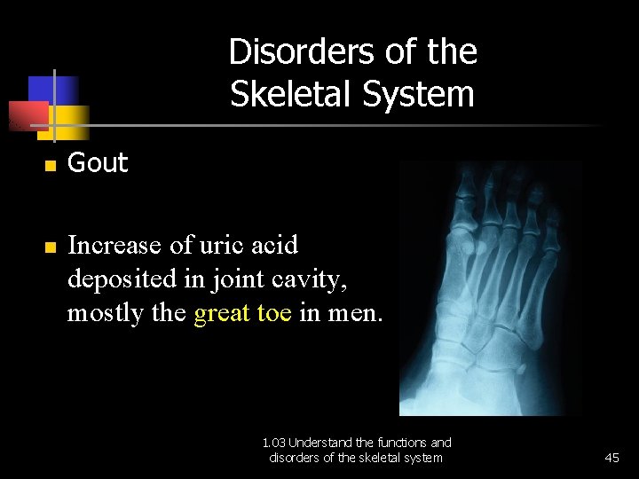 Disorders of the Skeletal System n n Gout Increase of uric acid deposited in