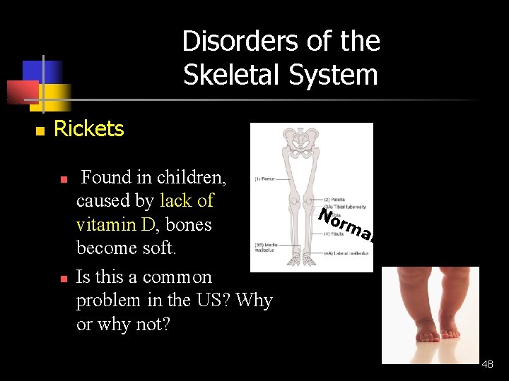 Disorders of the Skeletal System n Rickets n n Found in children, caused by