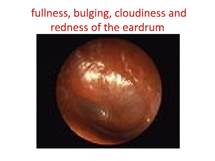  fullness, bulging, cloudiness and redness of the eardrum 