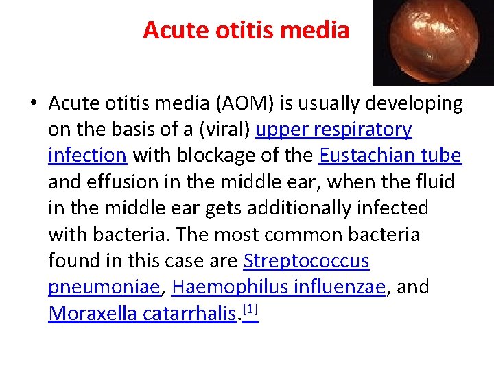 Acute otitis media • Acute otitis media (AOM) is usually developing on the basis