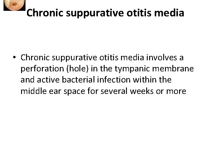 Chronic suppurative otitis media • Chronic suppurative otitis media involves a perforation (hole) in