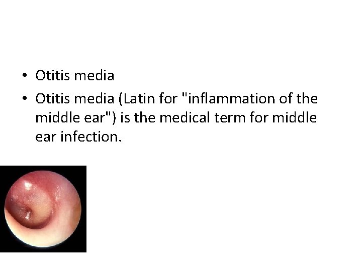  • Otitis media (Latin for "inflammation of the middle ear") is the medical