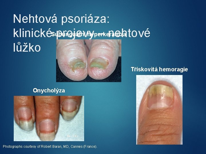 Nehtová psoriáza: Subunguální hyperkeratóza klinické projevy – nehtové lůžko Třískovitá hemoragie Onycholýza Photographs courtesy