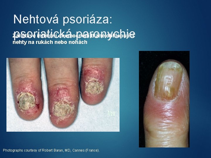 Nehtová psoriáza: Zánětlivé infekční onemocnění tkáně obklopující psoriatická paronychie nehty na rukách nebo nohách