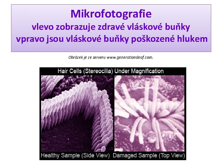 Mikrofotografie vlevo zobrazuje zdravé vláskové buňky vpravo jsou vláskové buňky poškozené hlukem Obrázek je