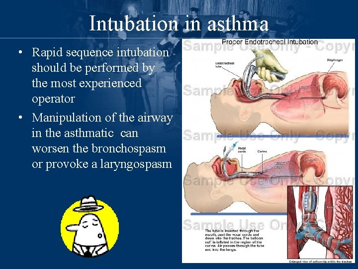 Intubation in asthma • Rapid sequence intubation should be performed by the most experienced