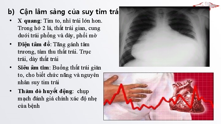 b) Cận lâm sàng của suy tim trái: • X quang: Tim to, nhĩ