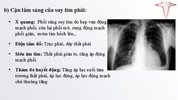 b) Cận lâm sàng của suy tim phải: • X quang: Phổi sáng suy