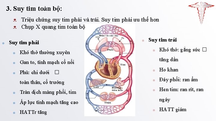 3. Suy tim toàn bộ: ᴥ Triệu chứng suy tim phải và trái. Suy