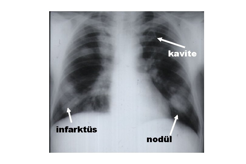 kavite infarktüs nodül 