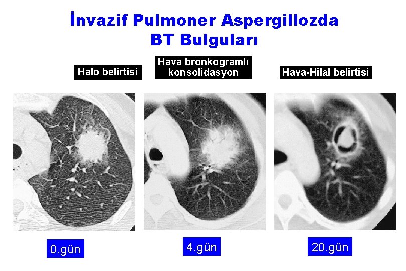 İnvazif Pulmoner Aspergillozda BT Bulguları Halo belirtisi 0. gün Hava bronkogramlı konsolidasyon 4. gün