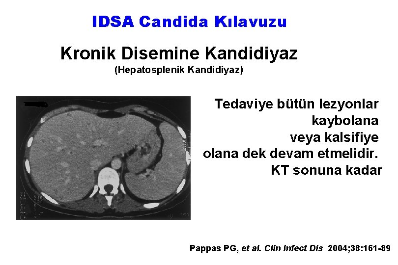 IDSA Candida Kılavuzu Kronik Disemine Kandidiyaz (Hepatosplenik Kandidiyaz) Tedaviye bütün lezyonlar kaybolana veya kalsifiye